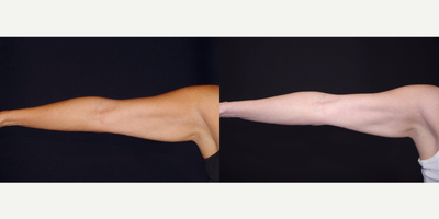 45-54 year old woman treated with Venus Legacy (and CoolSculpting) - 48 year old female received CoolSculpting and Venus Legacy to the arms; photos depict the patient's results 6 months post-CoolSculpting and 3 months post-Venus Legacy.