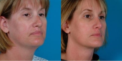 35-44 year old woman treated with Chin Liposuction - Procedure: Submental liposuction, rhinoplasty, scar revision of upper lip, and laser treatment of facial spider veins.