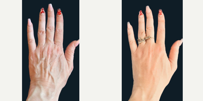 55-64 year old woman treated with Hand Rejuvenation - Hands change over time and give away our age. This patient was treated with a magic mix of fillers to restore plumpness and to add collagen and elastin to her hands.