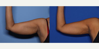 51 year old woman treated with Liposuction, Arm Lift - She underwent BodyTite liposuction to her arms done while she was awake. She is shown 7 months after the procedure.