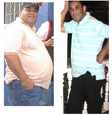 58 years old male, treated with gastric bypass - 58  years old male ,  treated  with a  gastric bypass. he had 300 pounds at the time of surgery, with   obesity associated diseasses  like Hypertension, Diabetes, Sleep Apnea, fluid retention, severe pain in the legs, back and chest. this it is  him  three years after  surgery. he  weighs 188 pounds  (down  112 pounds) and is a new and happy  person, all the obesity associated diseasses are gone.