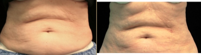45-54 year old woman treated with UltraShape - Before and after 6 weeks post 3 treatments of UltraShape and Vela3.
