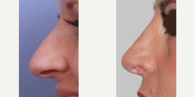 35-44 year old woman treated with Revision Rhinoplasty - Dr. Holden performed a revision of this woman's rhinoplasty. He removed the hump, rotated it slightly and built support for the tip.