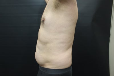 Traditional vs Vaser Liposuction In Adelaide - Cosmos Clinic