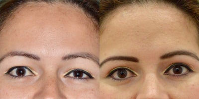 25-34 year old woman treated with Eyelid Surgery, Ptosis Surgery - Female patient treated with Eyelid Surgery , Ptosis Surgery.
