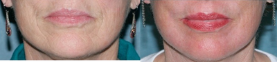 Fractional CO2 Laser Treatment - 
	A Fractional CO2 laser treatment improves the area around the patient&#39;s mouth.
