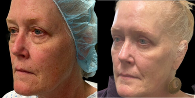 55-64 year old woman treated with Eyelid Surgery - Quad-blepharoplasty, upper and lower blepharoplasty.