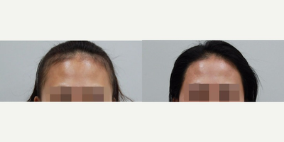 18-24 year old woman treated with Forehead Reduction - Forehead Reduction