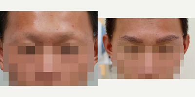 25-34 year old man treated with Eyebrow Transplant - Eyebrow Transplant