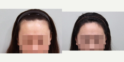 25-34 year old woman treated with Forehead Reduction - Forehead Reduction