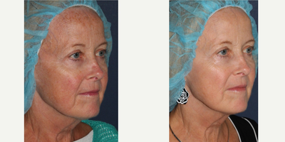 60 year old woman treated with IPL - Woman with age spots on the face is treated with a combination IPL and VBeam laser treatment