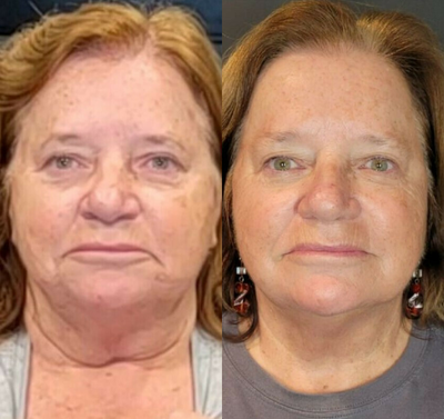 Woman treated with Sofwave - Photo provided courtesy of Sofwave, performed by Smile & Skin Aesthetics