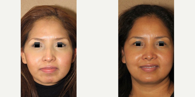 Woman treated with Chin Surgery - Woman treated with Chin Surgery