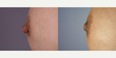 30 year old woman treated with Nipple Surgery - 30 year old woman treated with Nipple Surgery - Areola Correction