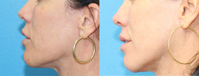 45-54 year old woman treated with Microneedling - Patient desired smoother, resurfaced skin, she is post 2 DermaPen treatments and will continue to see results