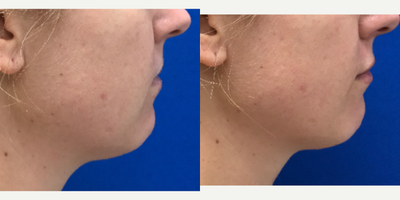 25-34 year old woman treated with Lip Augmentation - Look at that lip projection. She has more filler left. We are saving a bit to accent the cupids bow possible next time +_