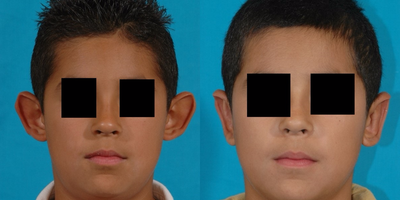 17 or under year old man treated with Ear Surgery - 10 year old male unhappy with the appearance of his protruding ears, consulted with Dr. Olson who recommended an otoplasty procedure (ear pinning).