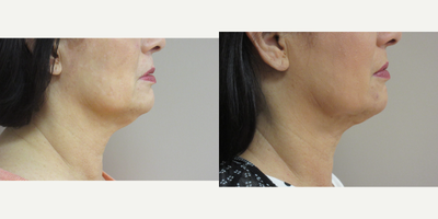 Chin Liposuction, Neck Lift - Patient had a neck lift with liposuction.