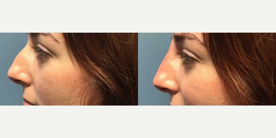 Woman treated with Nonsurgical Nose Job - Woman treated with Nonsurgical Nose Job.
