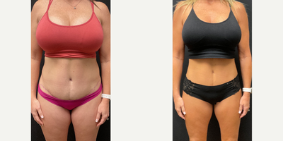 45-54 year old woman treated with Ozempic for Weight Loss - Patient lost 27lbs in 8 months on our Skinny Shot (Semaglutide).