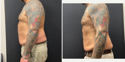 45-54 Man: 45-Pound Ozempic Side-View Result Ozempic before and after men transformation
