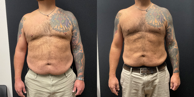 45-54 year old man treated with Ozempic for Weight Loss - Patient lost 45lbs in 7 months on our Skinny Shot (Semaglutide)