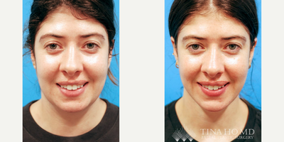 25-34 year old woman treated with Mini Neck Lift, Chin Filler, Neck Lift - 33 year-old female who underwent deep mini neck lift with chin augmentation with filler for jawline contouring and neck rejuvenation