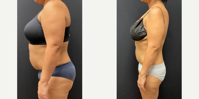 Woman treated with Semaglutide - Woman treated with Semaglutide