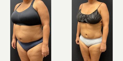Woman treated with Semaglutide - Woman treated with Semaglutide