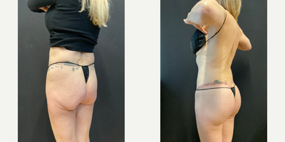 Woman treated with Butt Lift - Woman treated with Butt Lift