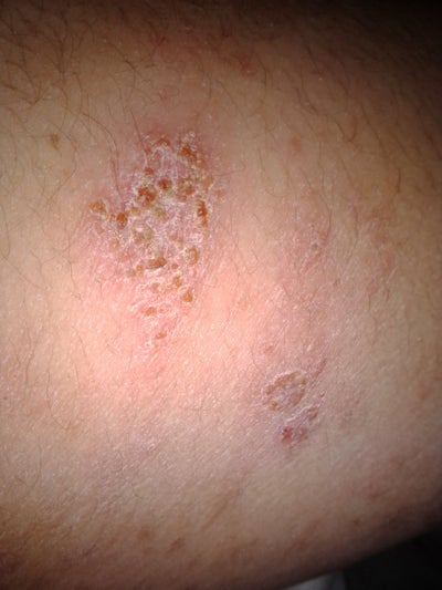 What is this? I have it on the inside of both arms and armpits. My skin ...