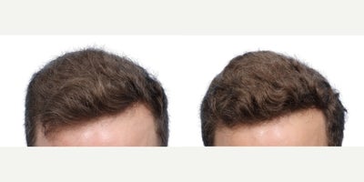 40 year old man treated with FUE Hair Transplant, PRP for Hair Loss - Goals: To restore and strengthen his front hairline and density on the crownProcedure: FUE hair transplant and PRP Hair TherapyGrafts: 3550 grafts, zones 1 and 4Photo Timeline: 6 months post-op