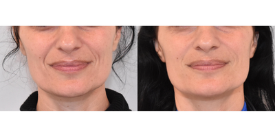 Dynamic Smile Lines Treated with Filler - This patient had lower facial dynamic lines that were more noticeable when smiling. Restylane Refyne was injected to soften creases around the mouth. After photos were taken two weeks post treatment.