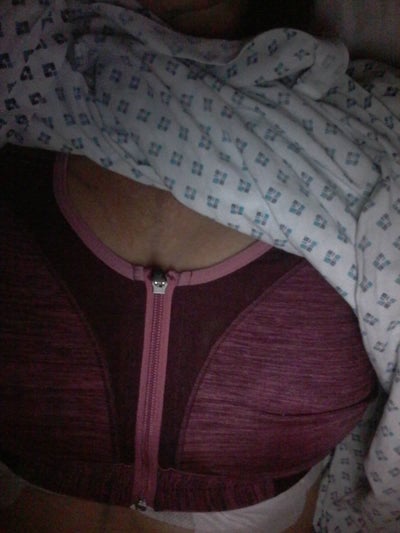 Finally Doing It - Breast Reduction 34F to 34C - Review - RealSelf