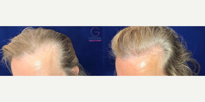 Man treated with Hair Loss Treatment - Man treated with Hair Loss Treatment using PRP injections to improve hairline as well as fullness and quality of hair.