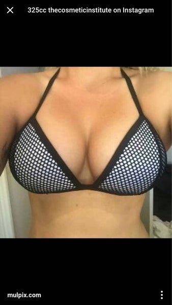 No more deflated breasts! 32C, 360cc, 110lbs, round, high profile