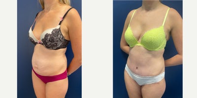 35-44 year old woman treated with Tummy Tuck, Liposuction, Power-Assisted Liposuction (PAL), Abdominal Etching, Umbilical Hernia - This beautiful mom of two underwent Tummy tuck with Liposuction, as well as Diastasis Recti Repair to create a flatter and more defined abdominal contour.  Her umbilical hernia was repaired and reconstructed at the same time creating a small innie belly button with minimal scarring on the outside.The scars will continue to fade over time.