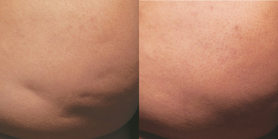 35-44 year old woman treated with Cellfina - Cellfina