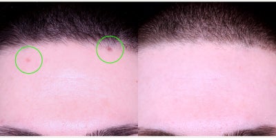 25-34 year old man treated with Vbeam - vascular laser (vbeam) for redness