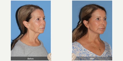 69 year old woman treated with Deep Plane Facelift, Facelift, Neck Lift, Dermal Fillers, MACS Facelift - 69 year old woman treated with Deep Plane Face and Neck Lift, Filler to the Temples and Chin, Laser to Face MAC