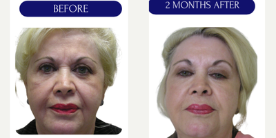 45-54 year old woman treated with Diluted Radiesse - Collagen biostimulation with DILUTED RADIESSEHyperdiluted Radiesse is Radiesse that has been diluted with a mixture of sterile saline solution and lidocaine. This makes it an easily spreadable bio stimulator capable of remodeling skin over a larger area. Hyperdiluted Radiesse is injected into areas of the skin that are loose as opposed to firm and stimulates the body to create new collagen. It is used to address concerns related to skin texture and laxity, such as fine wrinkles, creepiness, acne scars, cellulite, and saggy skin.