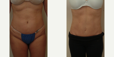 35-44 year old woman treated with Mini Tummy Tuck - Mini-Abdominoplasty