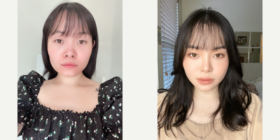 25-34 year old woman treated with Jaw Reduction - Mandible reduction- Square Jaw Reduction Zygoma reduction- (Malar) Cheekbone reduction Incisional Ptosis Correction Epicanthoplasty- Mongolian Folds ( Inner corner) Open Rhinoplasty (Bridge + Tip)Septal cartilage extension Hump removal Alar reduction Fat graft +Stem-cell-extract point -abdomen>undereye, smile line(nasolabial fold), front chin, forehead