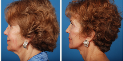 55-64 year old woman treated with SMAS Facelift - facial rejuvenation, concerned about her neck