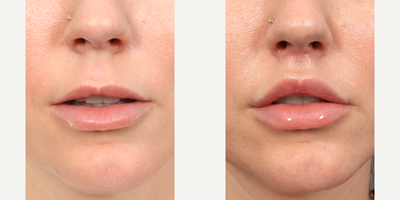 Dr. Lexie Wang performed an upper Lip Lift with a corner lip lift. - Dr. Lexie Wang performed an upper Lip Lift with a corner lip lift. This was performed under local anesthesia, the patient was awake. These results are 3 months post-op.