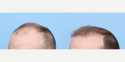 25-34 year old woman treated with FUE Hair Transplant, Hair Transplant, Hair Loss Treatment, PRP for Hair Loss, PRP Injections - This 28-year-old patient started noticing hair loss and had a lot of recession in temporal region. Dr. Wise performed an FUE hair transplant along with one session of PRP during the procedure to get these results. He will continue to see results up until 1 year mark.