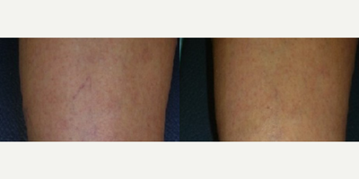 Woman treated with Excel V - Woman treated with Excel V