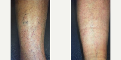 Woman treated with Excel V - Woman treated with Excel V