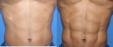 25-34 year old man treated with truSculpt flex - 25-34 year old man treated with truSculpt flexto tone and define his abdomen, shown 3 months post op.Patient kept the same diet and workout schedule the entire time receiving treatment and after.