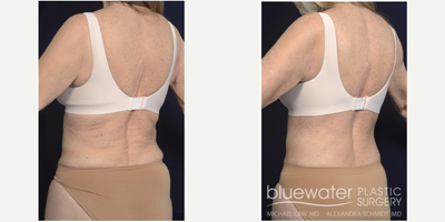 55-64 year old woman treated with Back Lift - 63 years - Bra-line back lift. Follow-up photo taken 3 months after the procedure.